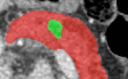 Deep Learning for Pancreatic Cancer Segmentation & Classification